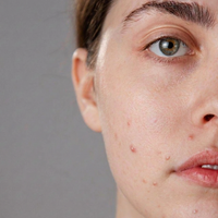 Acne Prone & Problem Skin