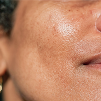 Dull & Dry Skin