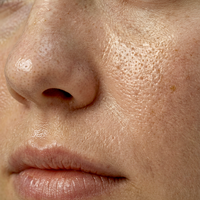 Dull & Oily Skin